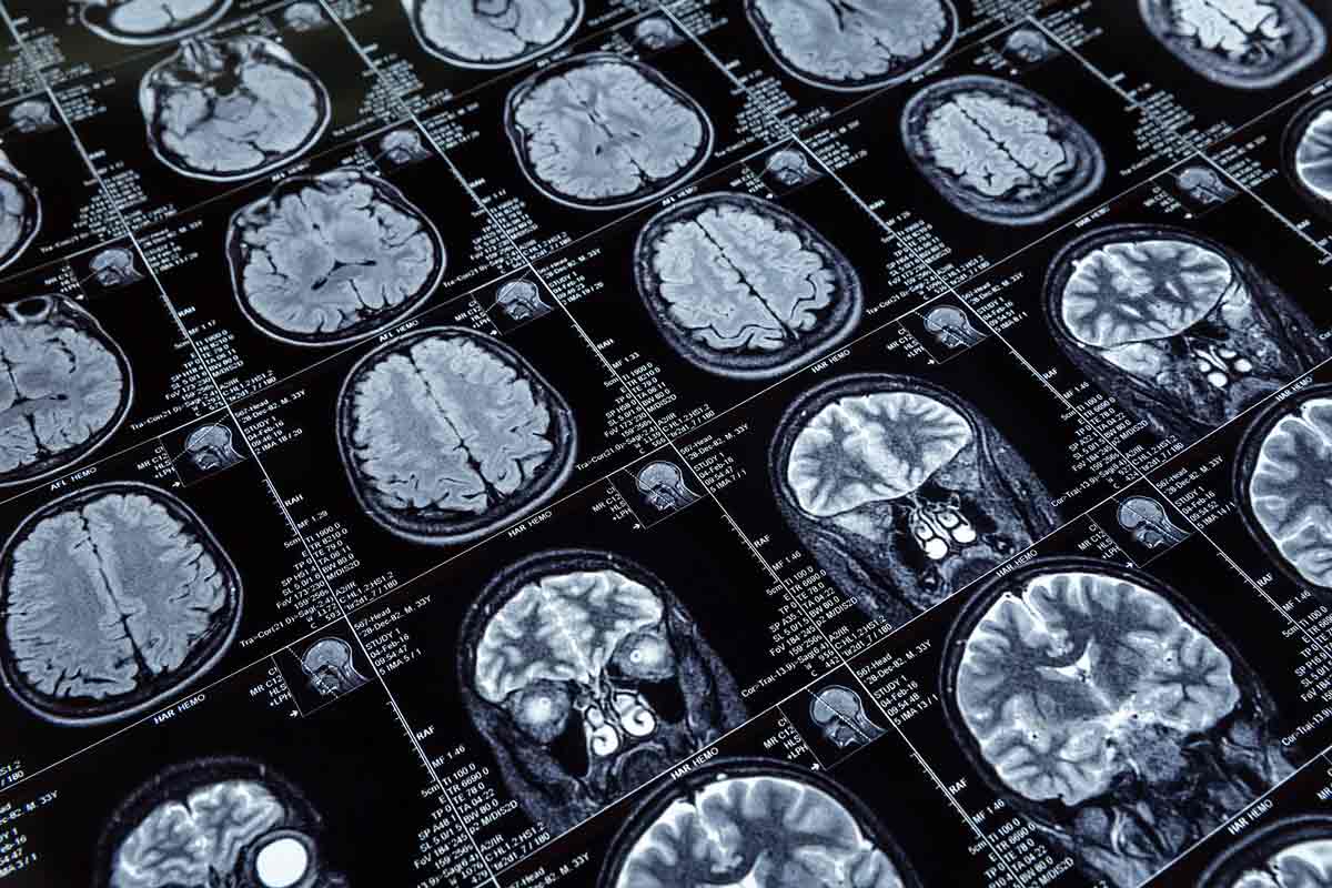 Topografie mozku u Alzheimerovy choroby